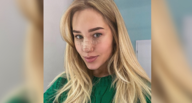 Победительница проекта «Холостяк-9» 24-летняя фотомодель Даша Квиткова решилась за пластику лица