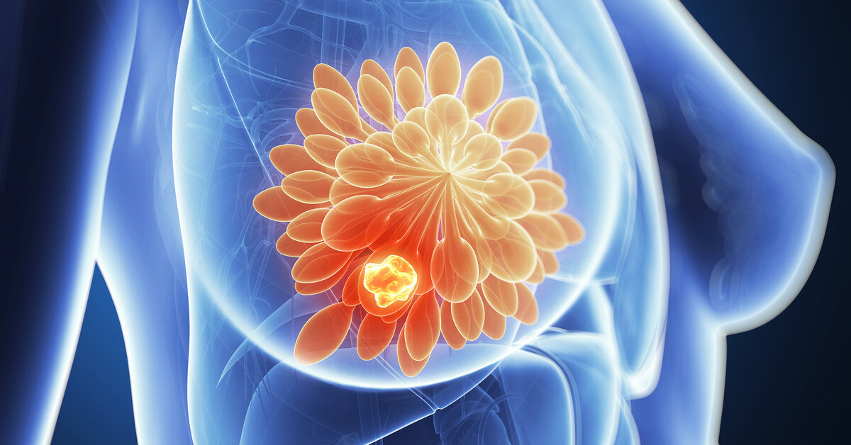 Развитие доброкачественных заболеваний молочных желез: классификация и факторы