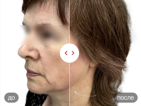 Нити Коги что это, показания и преимущества